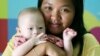 Pattaramon Chanbua, 21, poses her baby boy Gammy at a hospital in Chonburi province, southeastern Thailand Sunday, Aug. 3, 2014. 